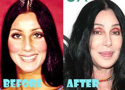 Cher Plastic Surgery Before And After Pictures Lovely Surgery