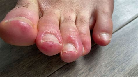 Covid Toes Could Skin Conditions Offer Coronavirus Clues Abc News