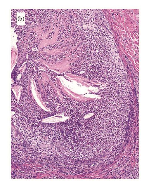 Histopathological Features A Lesion Of Acute Ruptured Suppurative