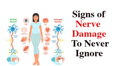 Signs Of Nerve Damage To Never Ignore Womenworking