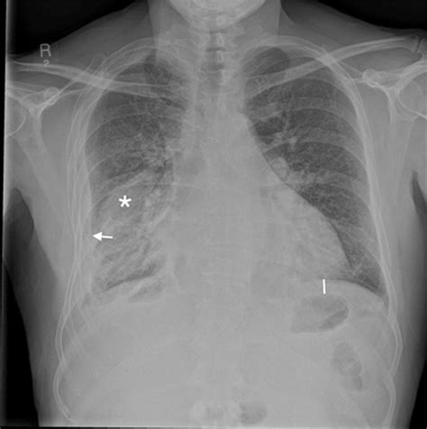 Chest Radiograph Showing An Encysted Pleural Effusion Lenticular