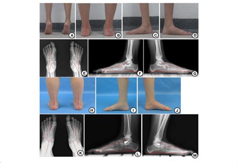 Appearance And X Ray Before And After Operation A Hindfoot Valgus Download Scientific