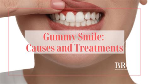 Gummy Smile Causes And Treatments Can It Be Fixed