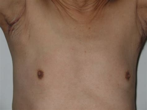 External Photography Of Patients Chest Showing Enlarg Open I