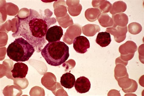 Lymphoplasmacytic Lymphoma Micrograph Photograph By Science Photo