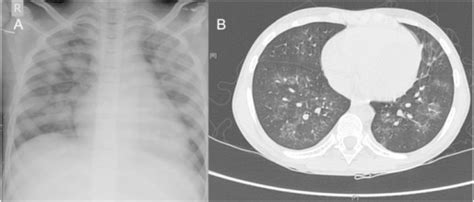 A Chest X Ray Showing Bilateral Nodular Infiltrates Open I