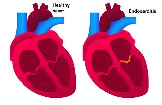 Cases of myocarditis may be the consequence of a direct cytopathic viral effect, increasing evidence implicates im Endocarditis - causes, symptoms and treatments | British ...