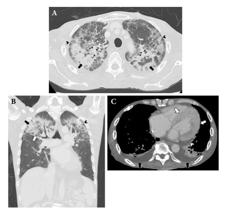 Imaging Features Of Pulmonary Involvement In A Case Of Systemic