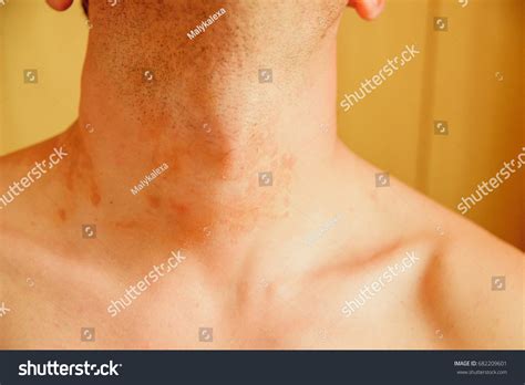 Allergic Skin Rash Spots On Neck Stock Photo 682209601 Shutterstock