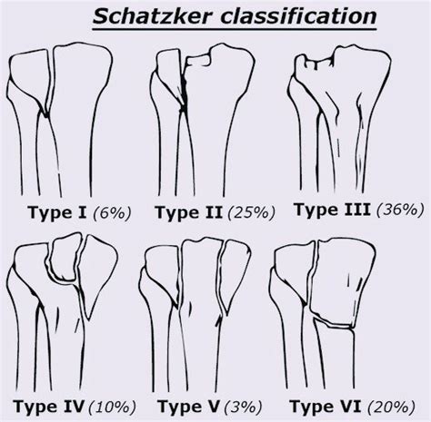 Schatzker Classification Pt Master Guide