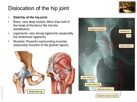 Imaging Anatomy Dislocation Of The Hip Joint