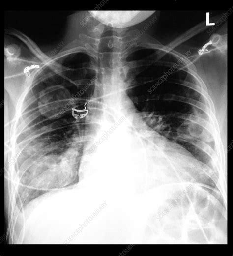 Chest X Ray Of Multiple Lung Masses Stock Image C0394111 Science