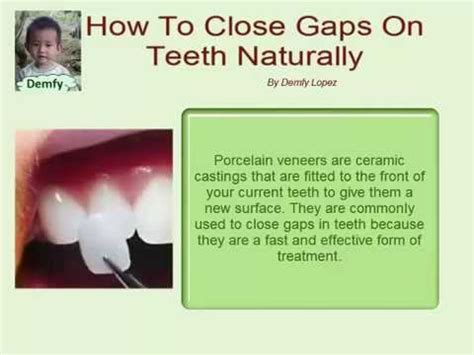 The need for braces, or not, depends entirely on why the gap has formed. How To Close Gaps On Teeth Naturally - YouTube