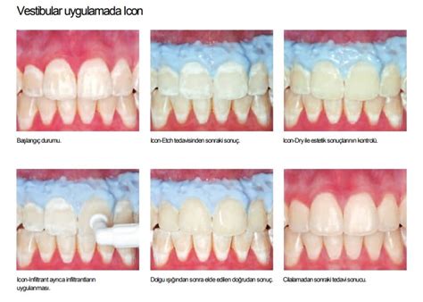 Dmg Icon Vestibular 2li Dental And Diş Sektöründe