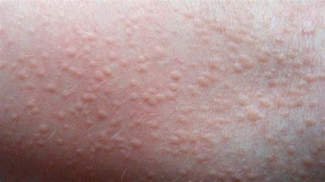 What Is Heat Rash — And Can You Prevent It Rashes Remedies Heat