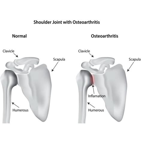 Joint Preservation And Cartilage Restoration Shoulder Surgeon South