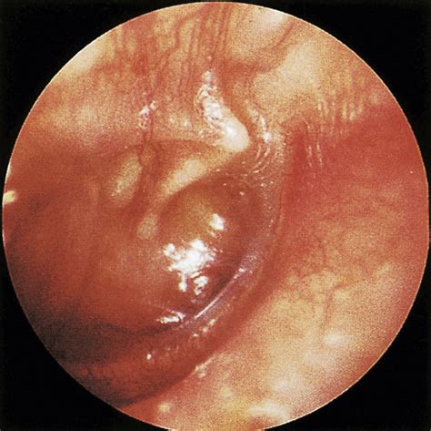 Otitis Media With Effusion Serous Secretory Otitis