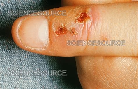 Photograph Herpetic Whitlow Science Source Images