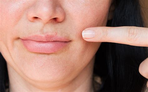 How To Get Rid Of Pimples On Your Lips With Ayurvedic Remedies Vedix