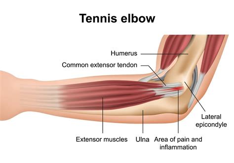 6 Effective Ways To Treat Elbow Tendon And Tendonitis