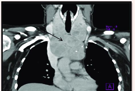 A Ct Image Coronal Section Showing Retrosternal Extension Of Goiter
