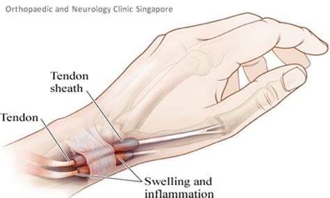 De Quervains Tenosynovitis Effective Wrist Treatment