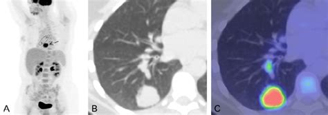 Expected Petct Findings In Lung Cancer With Nodal Metastatic Disease