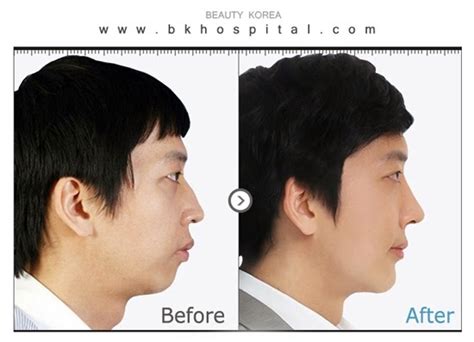 Eyelid Surgery Legend Dr Kim Byung Gun Bk Plastic Surgery Hospital