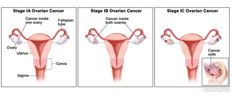 But ovarian cancer sometimes takes a while to diagnose because of the need to rule out other medical conditions. Ovarian Epithelial Cancer Treatment (PDQ®) | Cure Today
