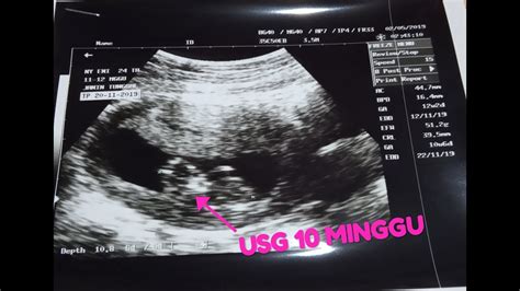 Manfaat mengetahui cara menghitung usia kehamilan. Gambar Usia Kehamilan 10 Minggu