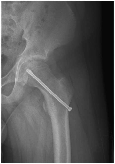 Patient 1 The X Ray Of The Left Hip After In Situ Fixation Download
