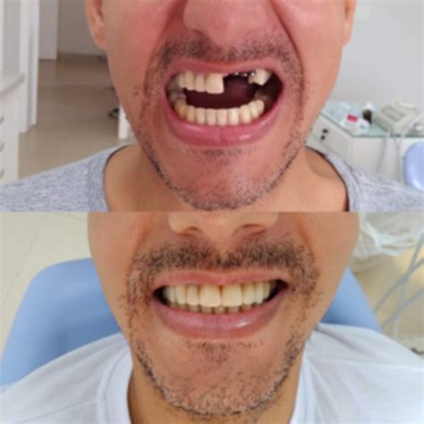 Implante Dentario Antes E Depois