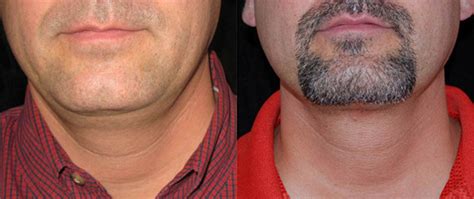 According to the american society of plastic surgeons, the laser hair removal treatment costs around $429 in the usa. Male Double Chin Removal Boston | Dr. Brooke Seckel
