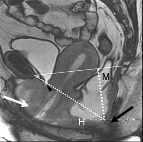Dynamic Mr Imaging Of The Pelvic Floor A Pictorial Review Radiographics