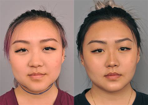 Buccal Fat Removal For Chubby Cheek Reduction Case 227