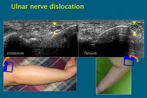 Peripheral Nerve Lesions Role Of High Resolution Us Radiographics