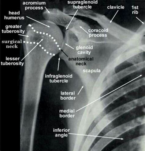 Radiografia Do Ombro Direito Radiology Schools Radiology Student