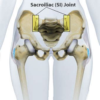 A dislocated hip can be very painful. Sacroiliac Joint Dysfunction Treatment & Pain Relief