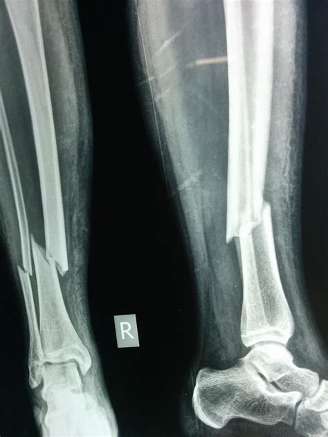 Tibia Shaft Fractures Trauma