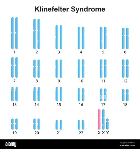 Klinefelter Syndrome Karyotype Stock Vector Images Alamy