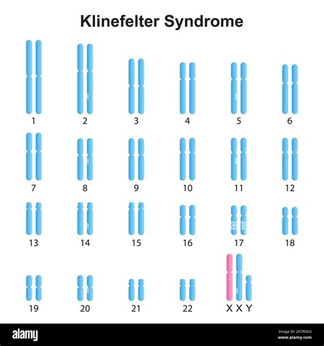 Klinefelters Syndrome Karyotype