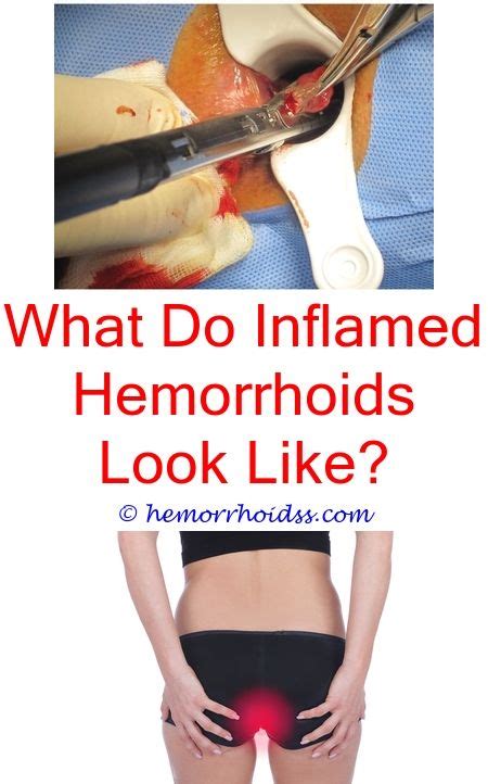 Can Hemorrhoids Bleed Without A Bowel Movement Bleeding Hemorrhoids Getting Rid Of