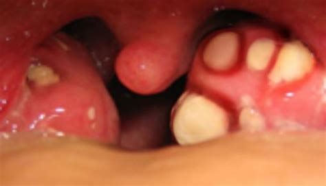 Tonsil Stones How To Get Rid Removal Causes Prevent Symptoms