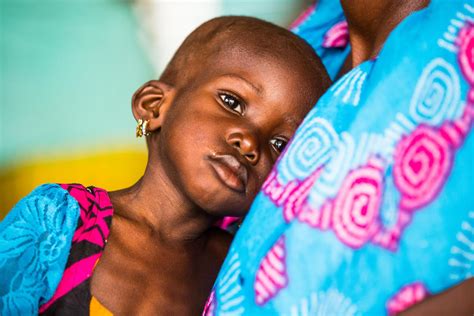 Un Half A Million Burkinabè Children Severely Malnourished Advert