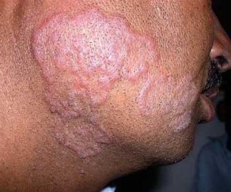 Medical Pictures Info Ringworm