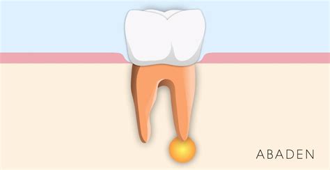 Tratamiento Del Absceso Dental ¿cómo Es Abaden Dentistas