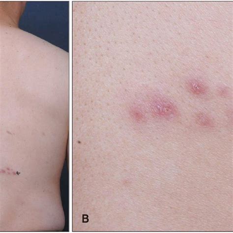 A Multiple Grouped Erythematous Papules Mimicking Herpes Infection On