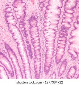 Microscopic Histology Tubular Adenoma Adenomas Premalignant库存照片
