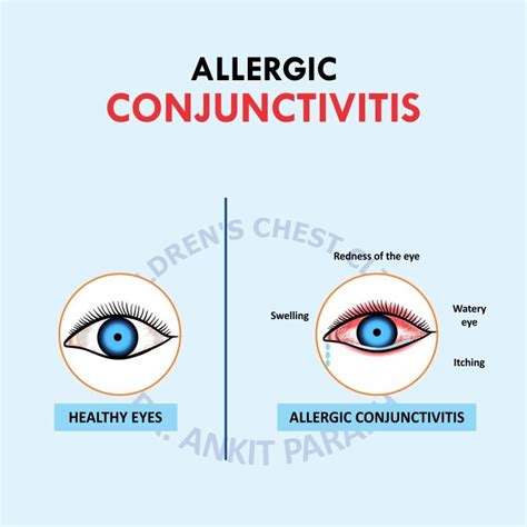 Allergic Conjunctivitis Or Eye Allergy Dr Ankit Parakh