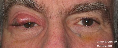 Chalazion Causes Symptoms Home Treatment Surgery Pictures Ehealthstar
